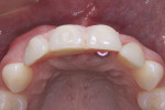 Fig 7. Occlusal view of screw-retained, cantilevered interim FDP, 3 months after immediate implant placement.
