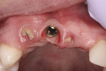 Fig 4. Intraoral view after removal of old implant crown and prior to fixed provisionalization.