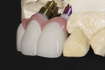 Fig 10. Monolithic zirconia framework with facial cutback to accommodate 3 porcelain veneers.