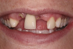 Fig 3. Frontal view of smile after right lateral incicor fractured.