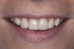 Fig 13. Post-treatment smile at the 1-month clinical follow-up.