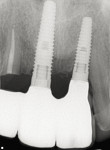 Fig 14. Periapical radiograph at the 2-year clinicalfollow-up.