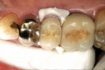 Figure 9: Occlusal view of removal of excess cement. Note the dislodgement of one large piece lingually.
