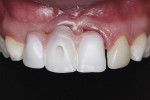 Fig 11. Frontal view of screw-retained, monolithic zirconia framework try-in.