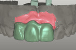 Fig 9. CAD prosthesis prior to milling.