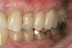 Figure 11  The final PFM restoration, permanently cemented into place with RelyX Luting Plus.