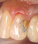 Figure 2  The enamel was beveled 2 mm to 3 mm surrounding the preparation (colored blue for illustration purposes).