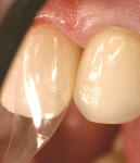 Figure 5  The paste resin was injected into the uncured flowable resin, and displaced to the periphery of the margins.