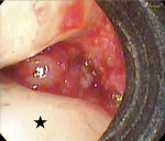Fig 3. View of the initial entry as seen with the videoscope. The mesial surface of tooth No. 3 is on the bottom of the image (black star).