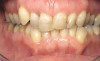 Fig 15. The implant-supported restoration of tooth No. 19 presented with a lack of attached keratinized gingiva, shallow buccal vestibule, and 2 mm of buccal recession.