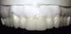 Fig 19. The circumferential defect was debrided. Note excess cement extending apically from the margin of the crown into the defect; residual cement has been shown to be complicit in the development of peri-implant disease.