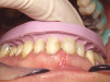 Fig 22. Copious irrigation with dilute hydrogen peroxide was used to chemically detoxify the surface of the implant and the bony defect.