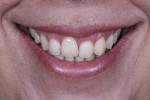 Fig 4.  Initial smile photograph shows inharmony and the abcense of the left maxillary central incisor.