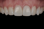 Fig 15.  Intraoral photograph of 18 months follow-up.