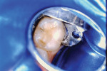 (1.) Preoperative photograph of a mandibular primary second molar