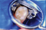 (2.) The tooth after cavity preparation of the occlusal surface only involving areas affected by caries.