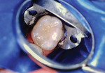(3.) Final restoration with a resin-modified glass-ionomer cement.
