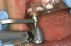 Fig 38. A reverse-torque screw was placed into the implant.