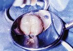 (5.) The tooth after Class II cavity preparation.