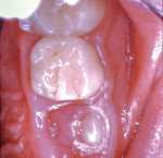 (6.) Final restoration with a resin-modified glass-ionomer cement after 4 years of effective clinical service.