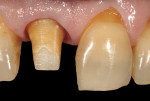(10.) After a fiber-reinforced foundation restoration system was used to build-up the missing coronal portion of the tooth and the core build-up was cured and secured, the tooth was prepared again with an angular shoulder finish line.
