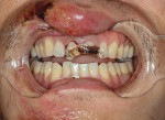 (1.) Intraoral picture immediately after the accident showing the fractured anterior teeth.