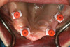 Fig 43. A full thickness flap was raised to place a new 3.25-mm implant into tooth No. 26 area in a single-stage protocol.