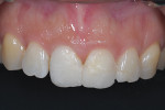 (5.) Intraoral frontal view of the provisional evaluating the smile line, incisal edge and midline.