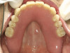 Fig 45. The definitive crown tooth No. 26 seated in place and provisionally cemented. The recession defect was eliminated with the removal and replacement of a new implant in the proper position.