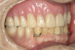 Figure 16  Complete denture seated firmly.