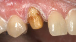 Figure 6  The prepared canine after using a diode laser on the mesial aspect of the tooth. Note the severe discoloration.