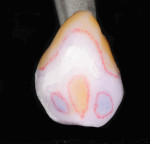 Figure 10  The crown was removed from the tooth and secured from the lingual.
