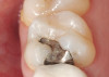 Fig 12. Fixed orthodontic treatment after placement of provisional crowns on teeth nos. 8 and 9.
