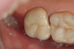 Figure 2  Failed zirconia restoration on the upper-right second molar.