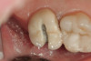 Fig 20. Extraoral view of final result; note the marked reduction of the gummy smile.