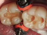 Figure 12  Two mandibular molars were excavated and prepared for restoration with composite resin.