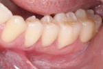 Fig 17. Buccal view of the completed inlays. Note the completely seamless transition from inlays to the tooth and the intact gingival tissue health.