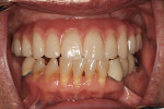 (13.) Occlusion following phase II of treatment plan.