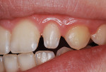 (1.) Diminutive lateral incisor in a 14-year-old girl.