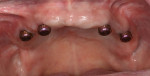 (4.) LOCATOR R-Tx retentive housings were placed on the abutments, then picked up in the dentures intraorally.