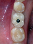 A clinical case showing a screw-access hole in the lower first molar.