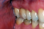 Another case with the Atlantis CustomBase solution in the upper first molar and the final restoration in place.
