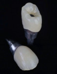 The Atlantis CustomBase solution provides a shared emergence between
abutment and crown.
