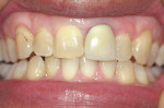 Figure 1  Preoperative view of defective crown on tooth No. 9 with discolored gingival area due to porcelain-metal crown.