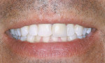 Figure 2  View of teeth after 2 weeks of bleaching.