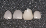 Figure 4  Restorations returned from the laboratory. Note the difference in the appearance of the porcelain of the crown and the veneers due to porcelain thickness.