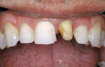 Figure 5  Etched enamel is frosty while the etched dentin is left slightly moist (glossy appearance) on tooth No. 9 crown preparation.
