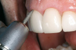 Figure 10  A flame-shaped diamond removes any excess porcelain and resin cement at the gingival margin.