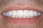 Figure 13  Completed restorations accomplish the smile the patient desires.