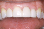 Figure 14  Completed restorations accomplish the smile the patient desires.